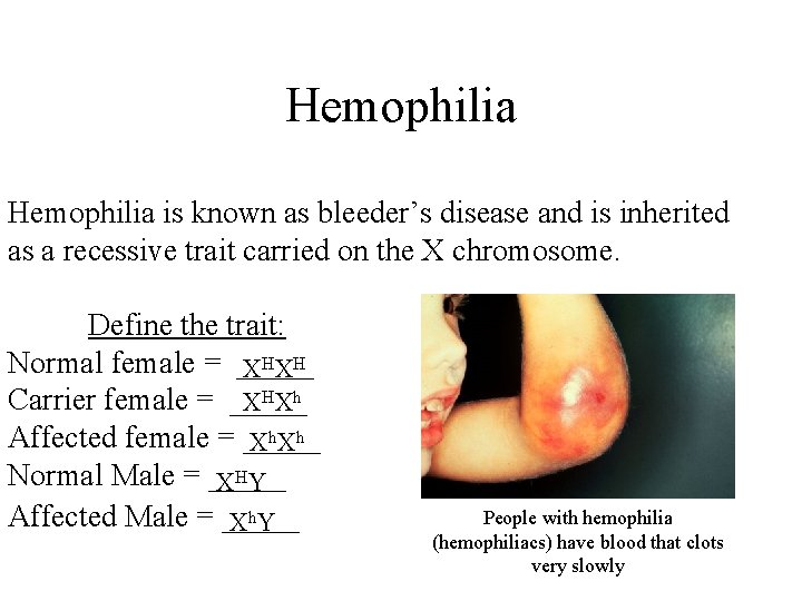 Hemophilia is known as bleeder’s disease and is inherited as a recessive trait carried