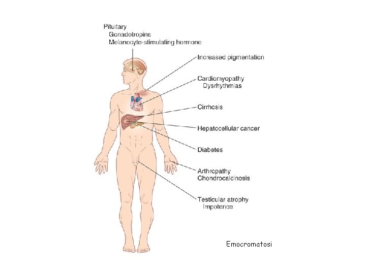 Emocromatosi 