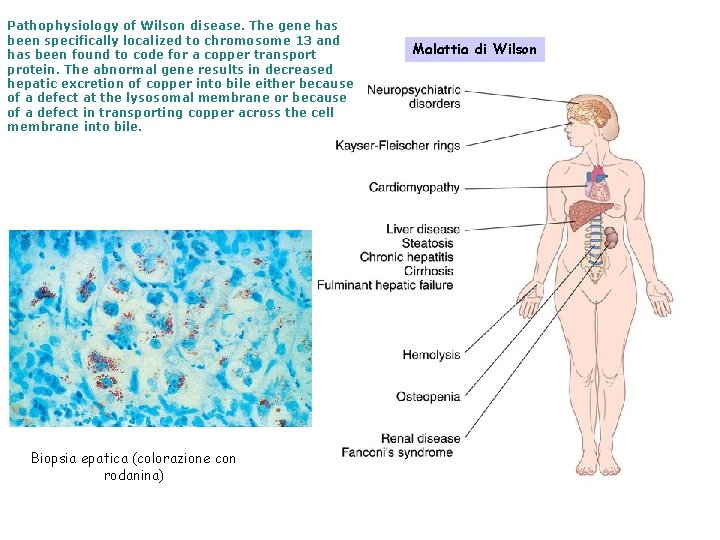 Pathophysiology of Wilson disease. The gene has been specifically localized to chromosome 13 and