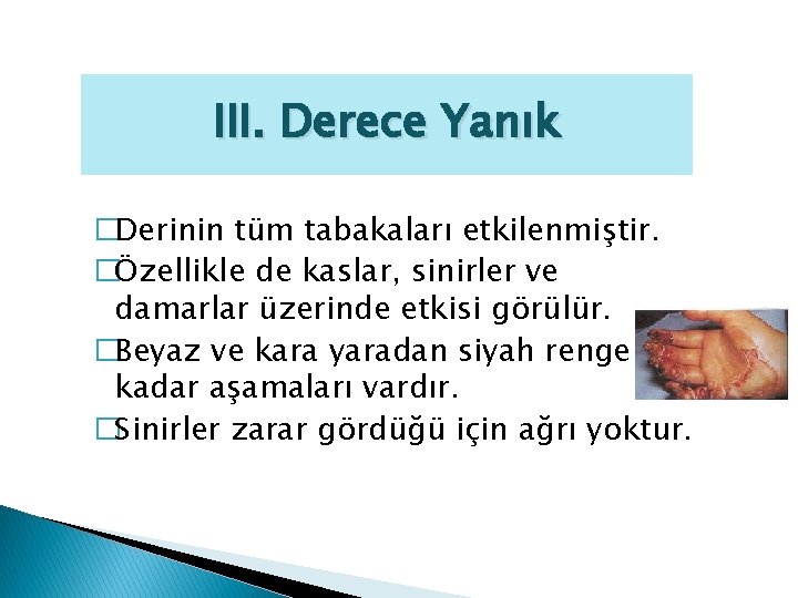 III. Derece Yanık �Derinin tüm tabakaları etkilenmiştir. �Özellikle de kaslar, sinirler ve damarlar üzerinde