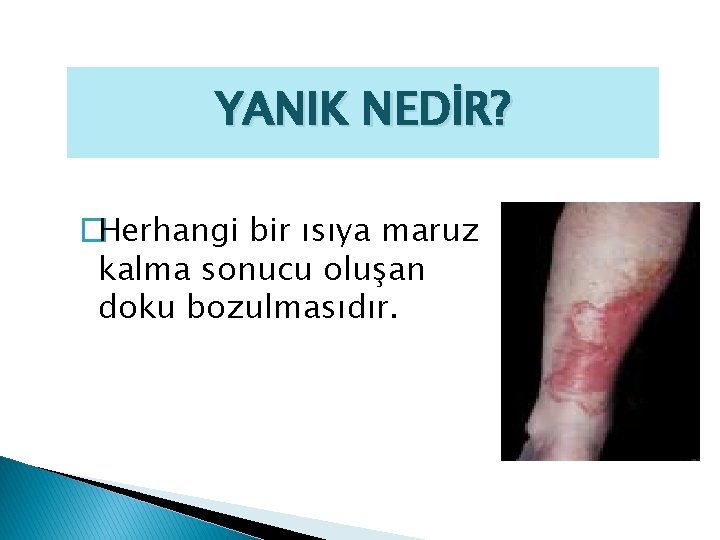 YANIK NEDİR? �Herhangi bir ısıya maruz kalma sonucu oluşan doku bozulmasıdır. 