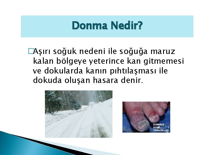 Donma Nedir? �Aşırı soğuk nedeni ile soğuğa maruz kalan bölgeye yeterince kan gitmemesi ve