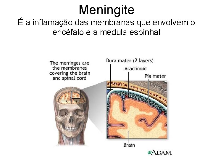 Meningite É a inflamação das membranas que envolvem o encéfalo e a medula espinhal