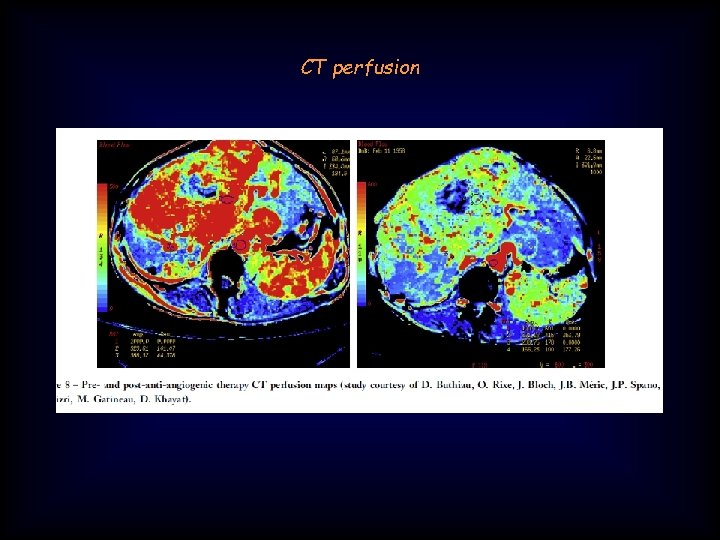 CT perfusion 