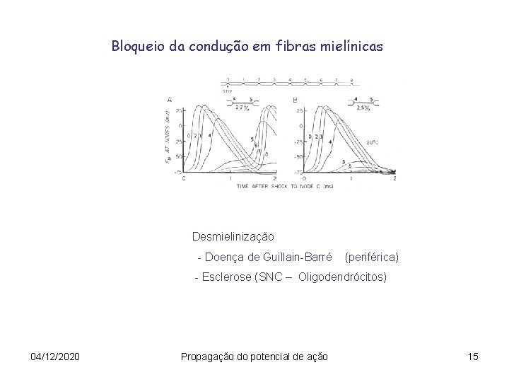 Bloqueio da condução em fibras mielínicas Desmielinização - Doença de Guillain-Barré (periférica) - Esclerose