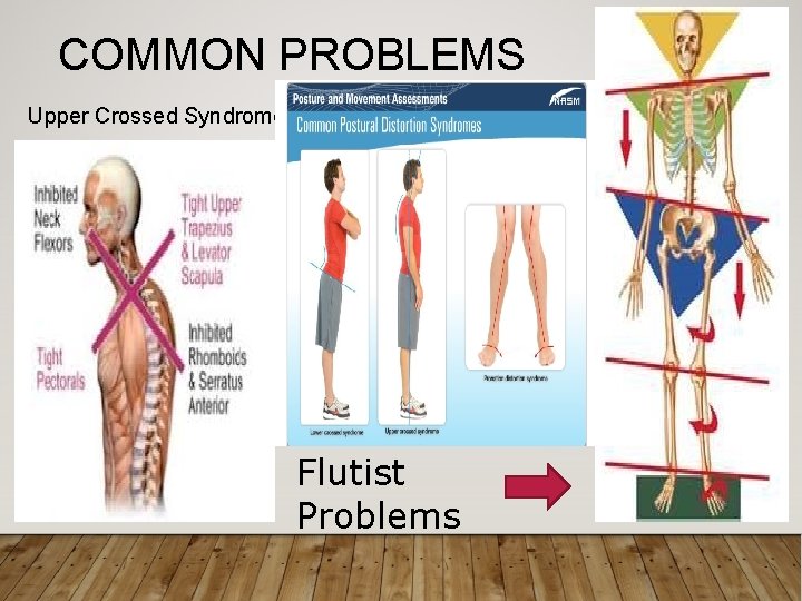 COMMON PROBLEMS Upper Crossed Syndrome Flutist Problems 