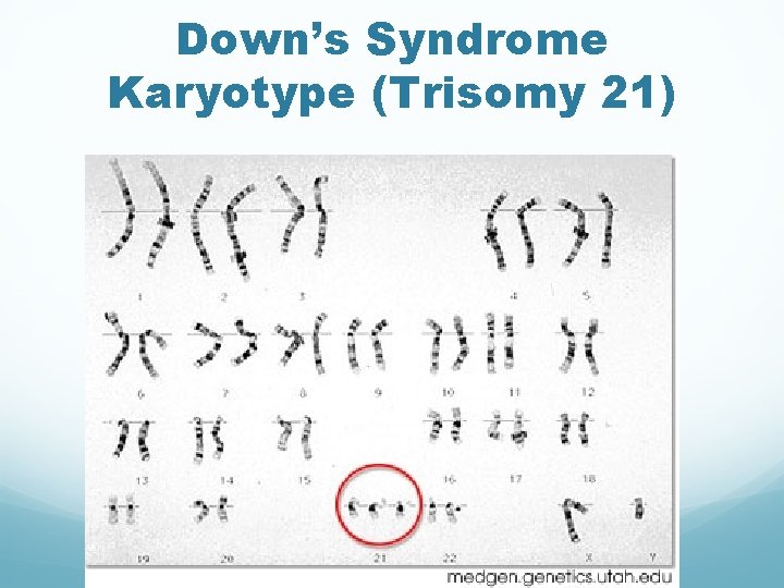Down’s Syndrome Karyotype (Trisomy 21) 