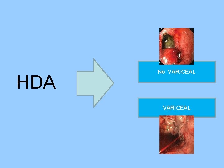 HDA No VARICEAL HDA No VARICEAL