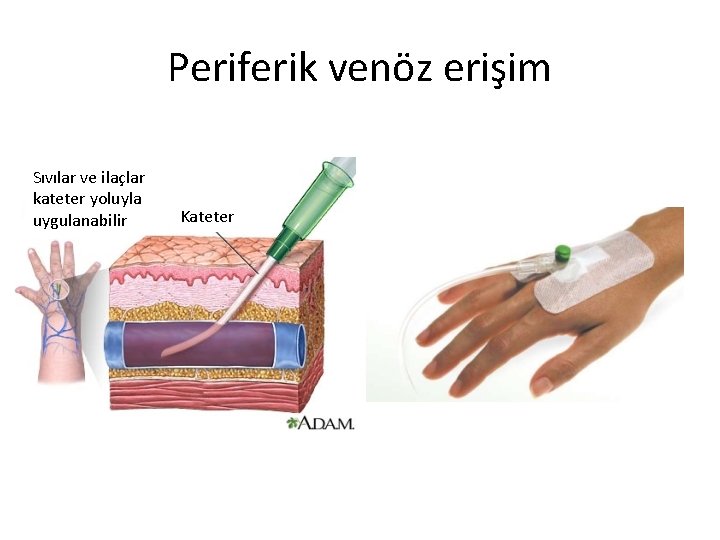 Periferik venöz erişim Sıvılar ve ilaçlar kateter yoluyla uygulanabilir Kateter 