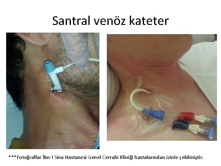 Santral venöz kateter ***Fotoğraflar İbn-I Sina Hastanesi Genel Cerrahi Kliniği hastalarından izinle çekilmiştir. 