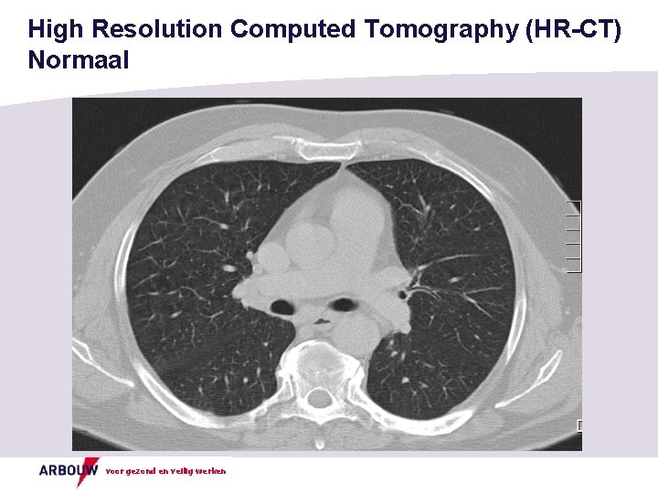 High Resolution Computed Tomography (HR-CT) Normaal voor gezond en veilig werken 