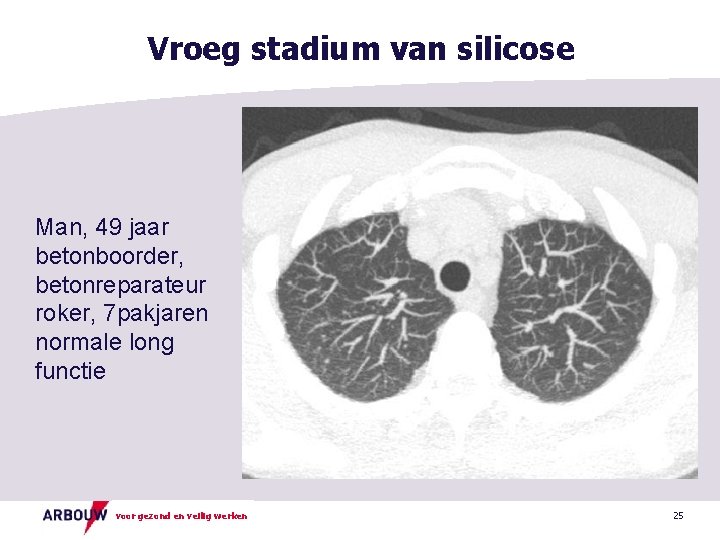 Vroeg stadium van silicose Man, 49 jaar betonboorder, betonreparateur roker, 7 pakjaren normale long