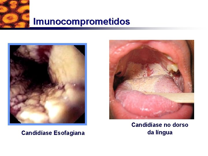 Imunocomprometidos Candidíase Esofagiana Candidíase no dorso da língua 