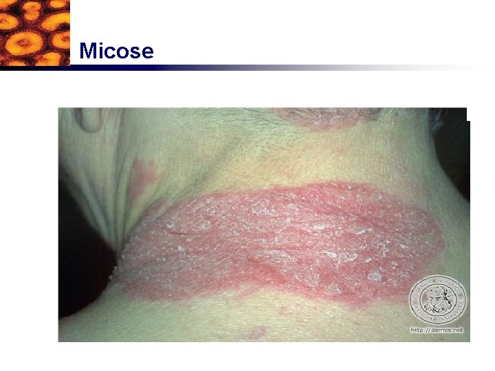 Micose 