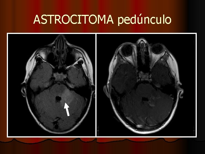 ASTROCITOMA pedúnculo ASTROCITOMA pedúnculo