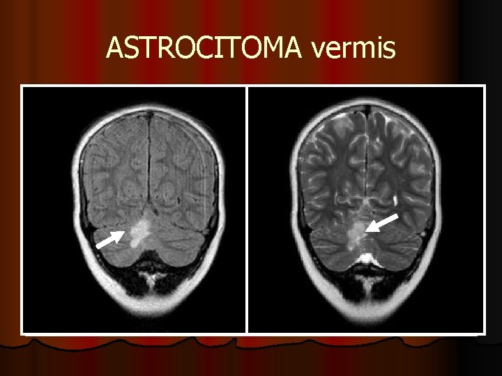 ASTROCITOMA vermis ASTROCITOMA vermis