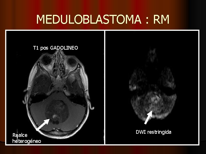 MEDULOBLASTOMA : RM T 1 pos GADOLINEO Realce heterogéneo DWI restringida MEDULOBLASTOMA : RM T 1 pos GADOLINEO Realce heterogéneo DWI restringida