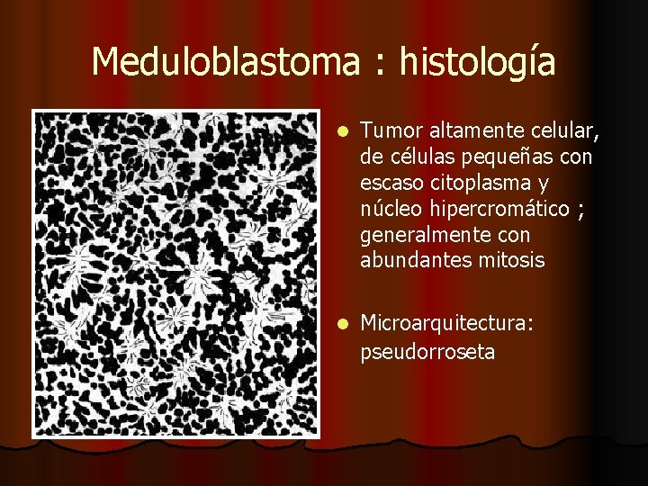 Meduloblastoma : histología l Tumor altamente celular, de células pequeñas con escaso citoplasma y Meduloblastoma : histología l Tumor altamente celular, de células pequeñas con escaso citoplasma y