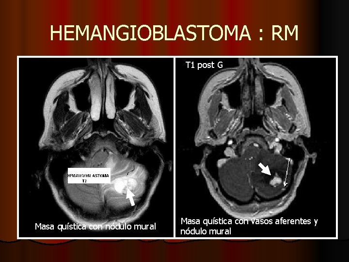 HEMANGIOBLASTOMA : RM T 1 post G Masa quística con nódulo mural Masa quística HEMANGIOBLASTOMA : RM T 1 post G Masa quística con nódulo mural Masa quística