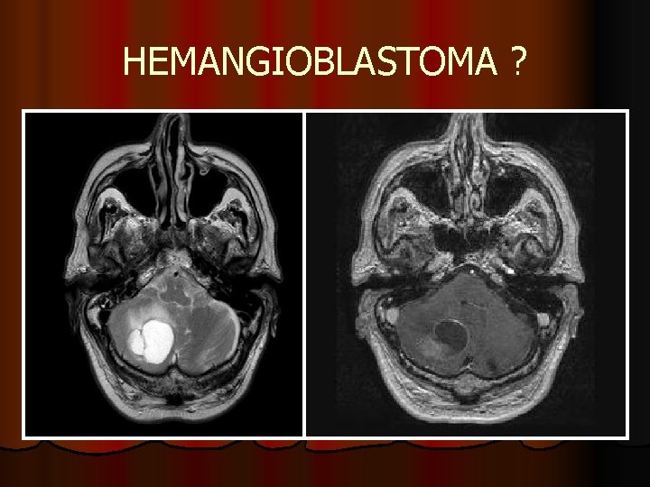 HEMANGIOBLASTOMA ? HEMANGIOBLASTOMA ?