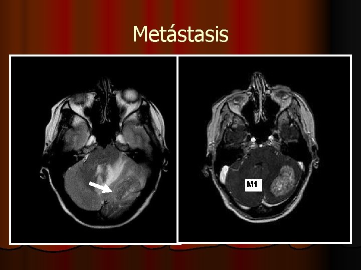 Metástasis Metástasis
