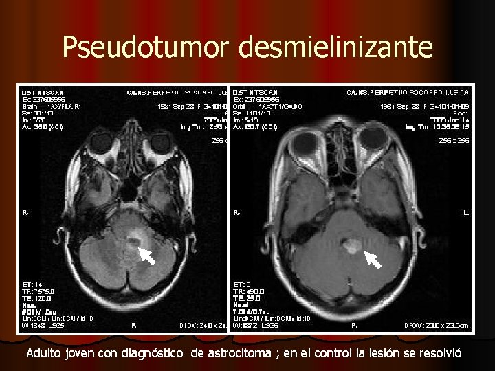 Pseudotumor desmielinizante Adulto joven con diagnóstico de astrocitoma ; en el control la lesión Pseudotumor desmielinizante Adulto joven con diagnóstico de astrocitoma ; en el control la lesión
