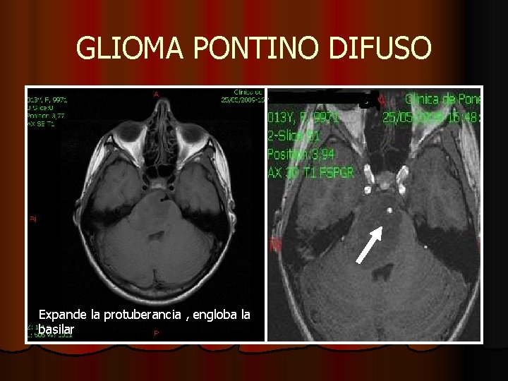 GLIOMA PONTINO DIFUSO Expande la protuberancia , engloba la basilar GLIOMA PONTINO DIFUSO Expande la protuberancia , engloba la basilar
