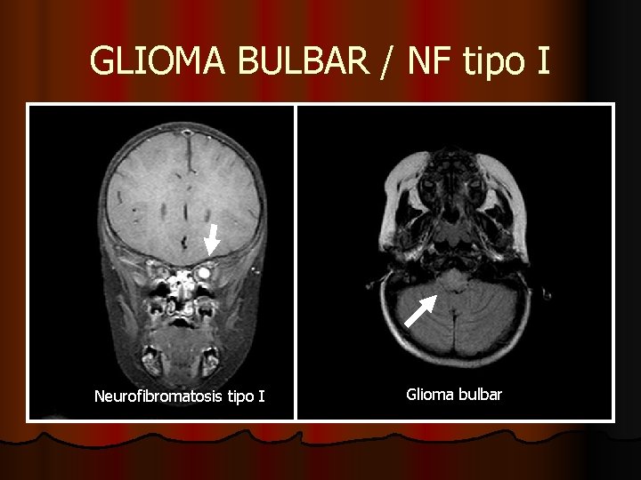 GLIOMA BULBAR / NF tipo I Neurofibromatosis tipo I Glioma bulbar GLIOMA BULBAR / NF tipo I Neurofibromatosis tipo I Glioma bulbar