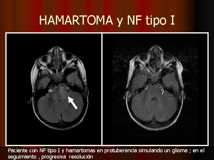 HAMARTOMA y NF tipo I ? Paciente con NF tipo I y hamartomas en HAMARTOMA y NF tipo I ? Paciente con NF tipo I y hamartomas en