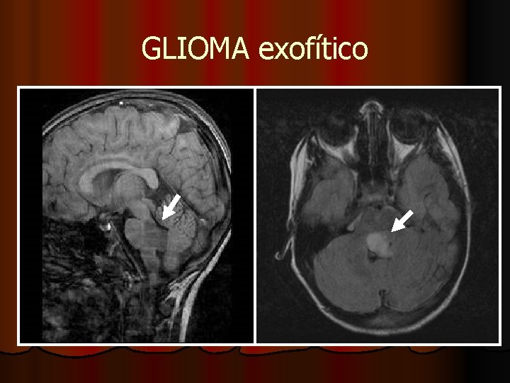 GLIOMA exofítico GLIOMA exofítico