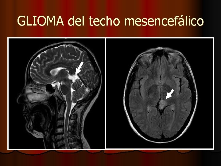 GLIOMA del techo mesencefálico GLIOMA del techo mesencefálico