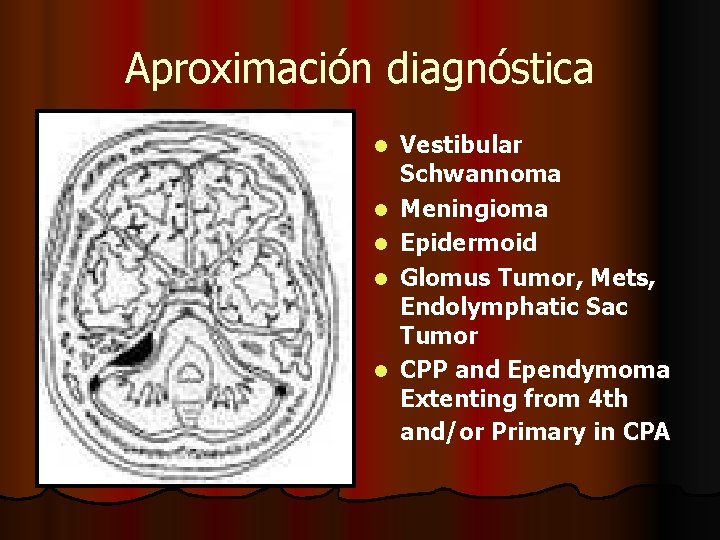 Aproximación diagnóstica l l l Vestibular Schwannoma Meningioma Epidermoid Glomus Tumor, Mets, Endolymphatic Sac Aproximación diagnóstica l l l Vestibular Schwannoma Meningioma Epidermoid Glomus Tumor, Mets, Endolymphatic Sac