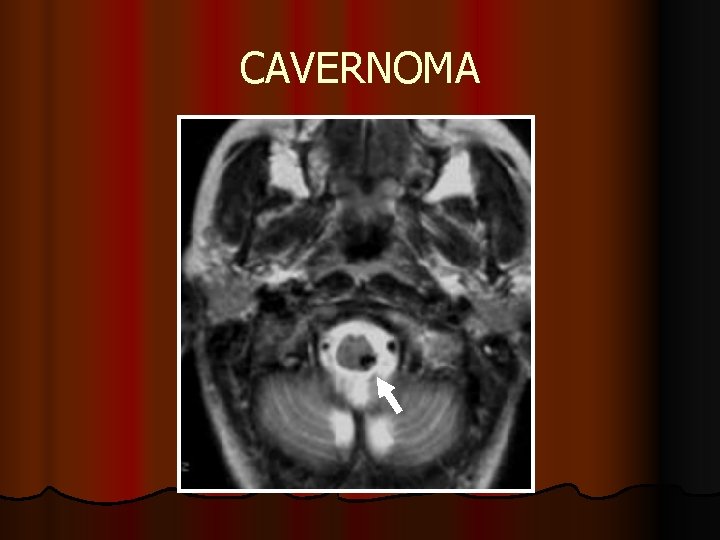 CAVERNOMA CAVERNOMA