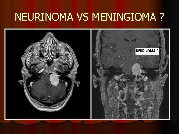 NEURINOMA VS MENINGIOMA ? NEURINOMA VS MENINGIOMA ?