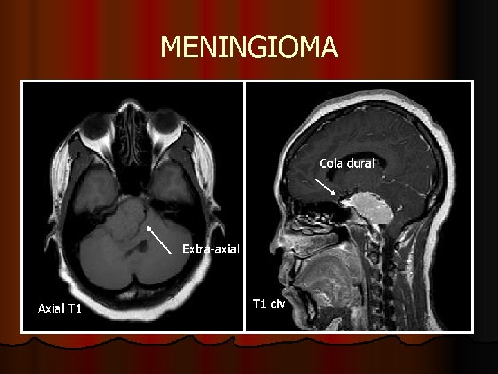 MENINGIOMA Cola dural Extra-axial Axial T 1 civ MENINGIOMA Cola dural Extra-axial Axial T 1 civ