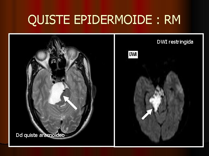 QUISTE EPIDERMOIDE : RM DWI restringida Dd quiste aracnoideo QUISTE EPIDERMOIDE : RM DWI restringida Dd quiste aracnoideo