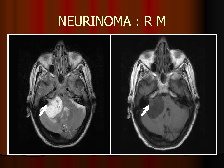 NEURINOMA : R M NEURINOMA : R M
