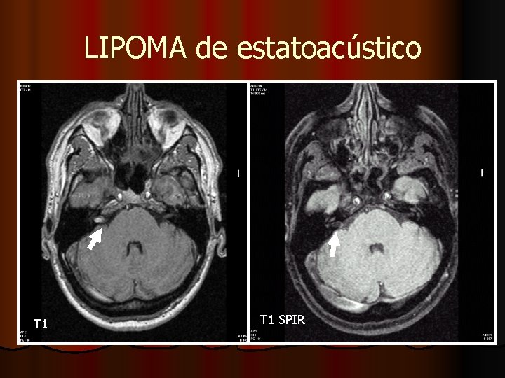 LIPOMA de estatoacústico T 1 SPIR LIPOMA de estatoacústico T 1 SPIR