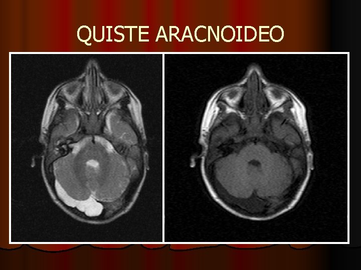 QUISTE ARACNOIDEO QUISTE ARACNOIDEO