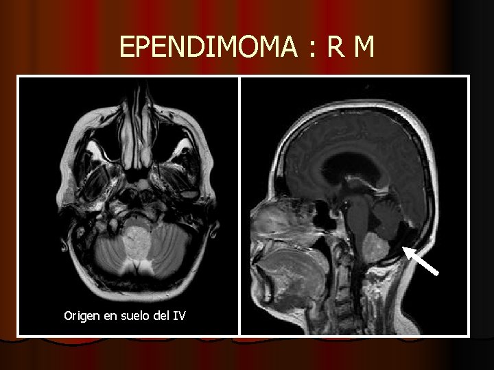 EPENDIMOMA : R M Origen en suelo del IV EPENDIMOMA : R M Origen en suelo del IV