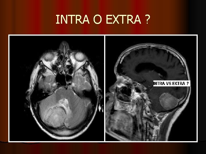 INTRA O EXTRA ? INTRA O EXTRA ?