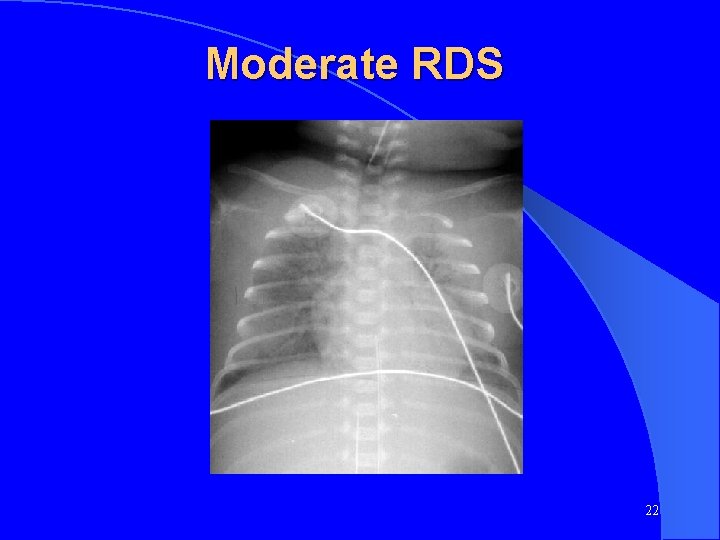 Moderate RDS 22 