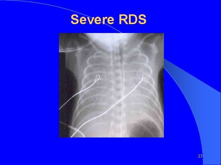Severe RDS 23 