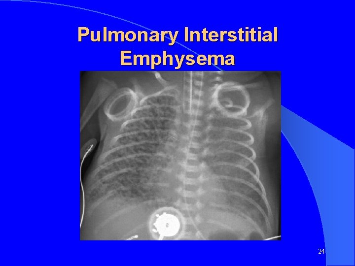 Pulmonary Interstitial Emphysema 24 