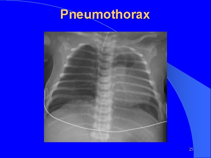 Pneumothorax 25 