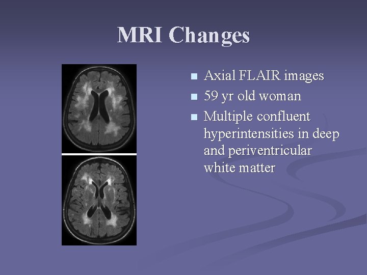 MRI Changes n n n Axial FLAIR images 59 yr old woman Multiple confluent