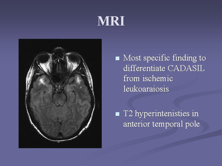 MRI n Most specific finding to differentiate CADASIL from ischemic leukoaraiosis n T 2