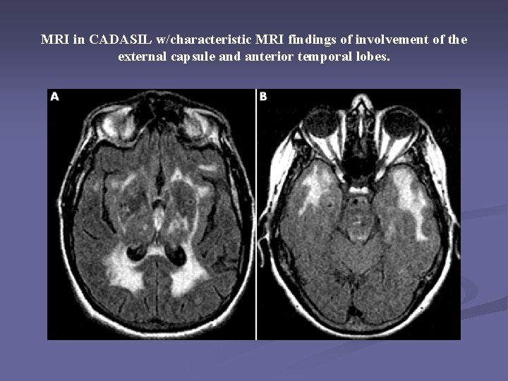 MRI in CADASIL w/characteristic MRI findings of involvement of the external capsule and anterior