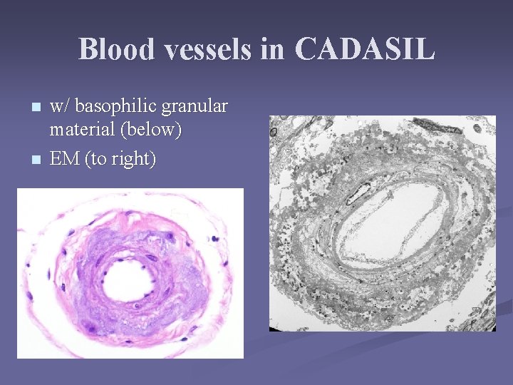 Blood vessels in CADASIL n n w/ basophilic granular material (below) EM (to right)