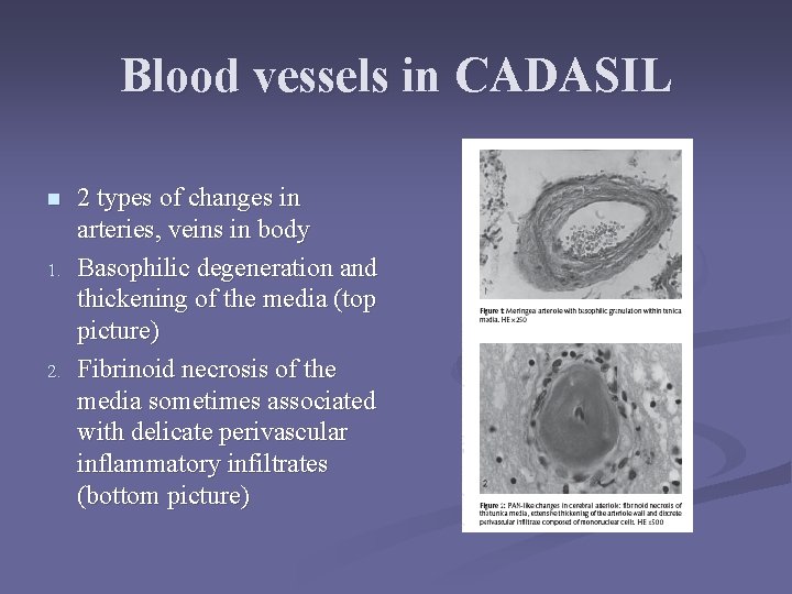 Blood vessels in CADASIL n 1. 2 types of changes in arteries, veins in